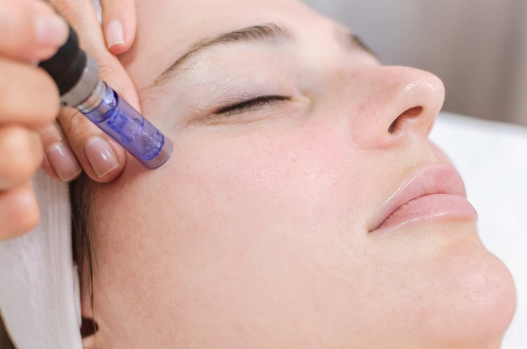 microneedling-skin-treatment.jpg